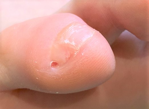 副爪、小指の横の爪施術後